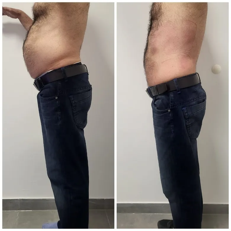 Vorher-Nachher: flacherer Bauch