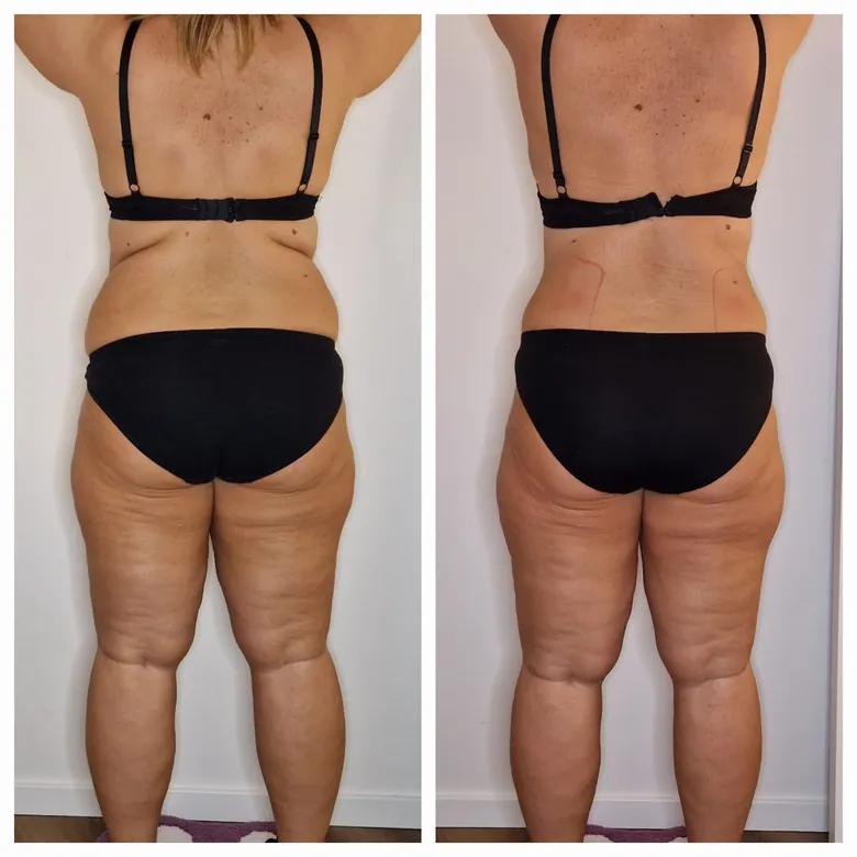 Vorher-Nachher: definierte Taille